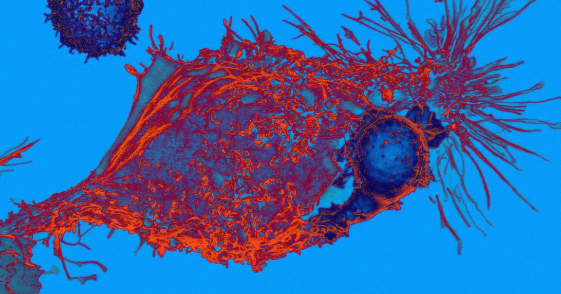 Scientists just published the results of the United States first trial of CRISPR-edited cells in cancer patients — and they're very encouraging.