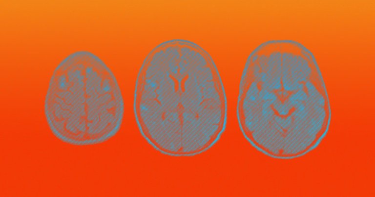 Scientists are warning that we may be overlooking serious brain disorders, triggered by the coronavirus that effect even those with mild symptoms.