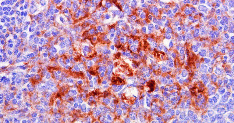 A rare neurodegenerative disease called Creutzfeldt-Jakob disease is becoming more common in Japan as its population ages.