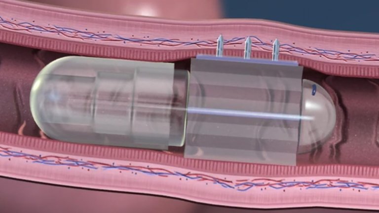 An experimental robot pill grows needles made of sugar when swallowed and inject medications — from inside someone's intestine.