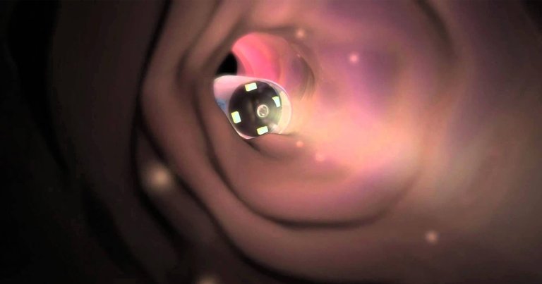 A group of 11,000 patients across England who have experienced symptoms of bowel cancer are lining up to receive a drug capsule with a camera inside of it.
