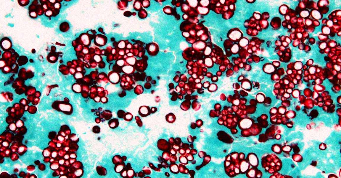 Tens of thousands of people in the US alone are being hospitalized by fungi a year, with millions more receiving treatment without being admitted.