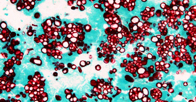 Tens of thousands of people in the US alone are being hospitalized by fungi a year, with millions more receiving treatment without being admitted.