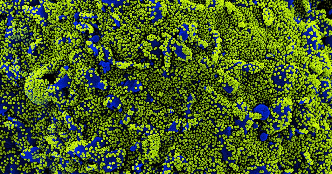 Preliminary research suggests a possible answer for why the delta variant of COVID-19 is so much more infectious than others.