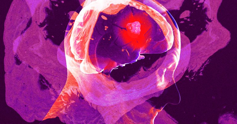 Scientists managed to 3D print a "viable" glioblastoma tumor so that they can develop better, more effective treatments for the deadly brain cancer.