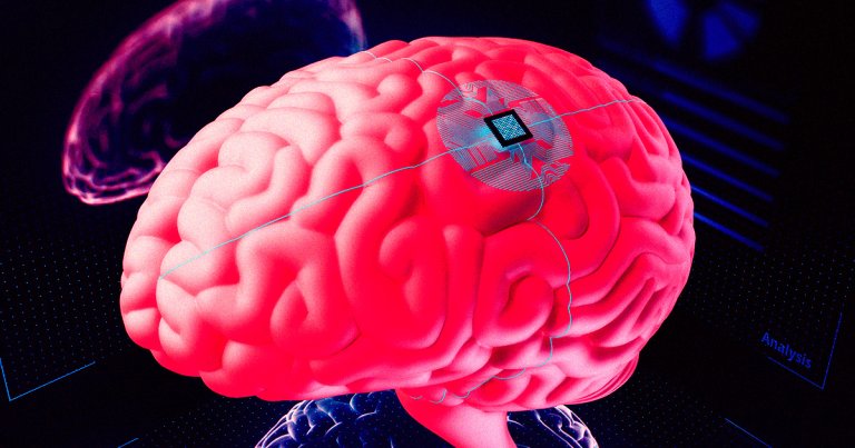A brain implant that zaps a woman's brain 300 times per day treated her severe depression after medications failed for years.