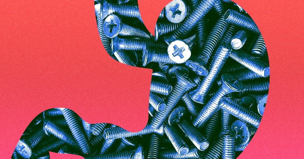 A man recently showed up to the hospital to have over two pounds of metal nails, screws, and other miscellanea removed from his stomach.