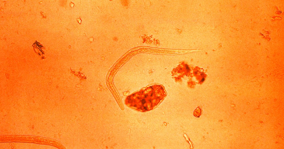 A Spanish man had a roundworm infection so bad that doctors could literally see the larvae slithering under his skin.
