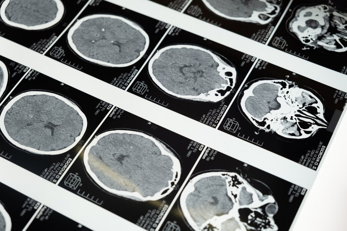 Nearly 20 years of Alzheimer's research could be undone after investigators uncover that a widely cited and influential paper may have used fabricated data.