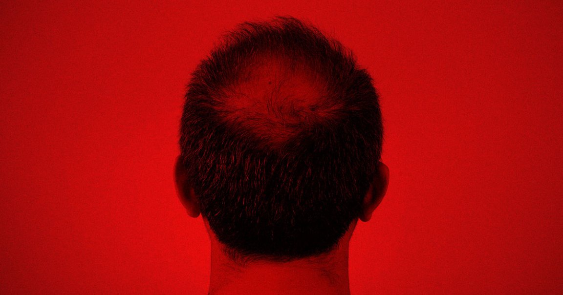 Low doses of minoxidil, the active ingredient in Rogaine, may reverse balding super cheaply — and yet most of us still haven't heard of it.