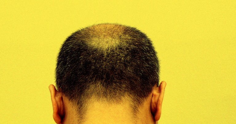 Using gene modification techniques, a team of researchers have come up with a new promising way to treat balding, a condition experienced by millions.