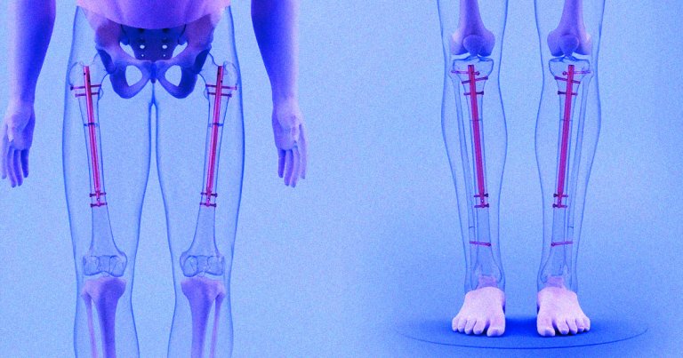 Some short men are so insecure about their heights that they are paying doctors to break their bones during surgical leg-lengthening procedures. 