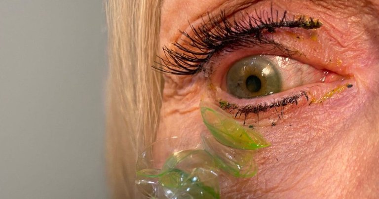 You might want to set aside your lunch if you're going to watch this video of nearly two dozen crusty contact lenses being extracted from an eye.