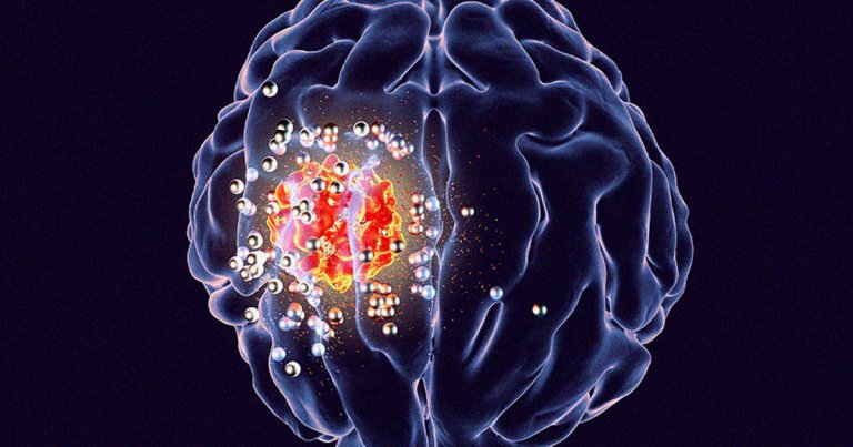 A team of researchers at Stanford Medicine have created what they hope will one day be a life-saving treatment for brain cancer: a wireless brain implant.