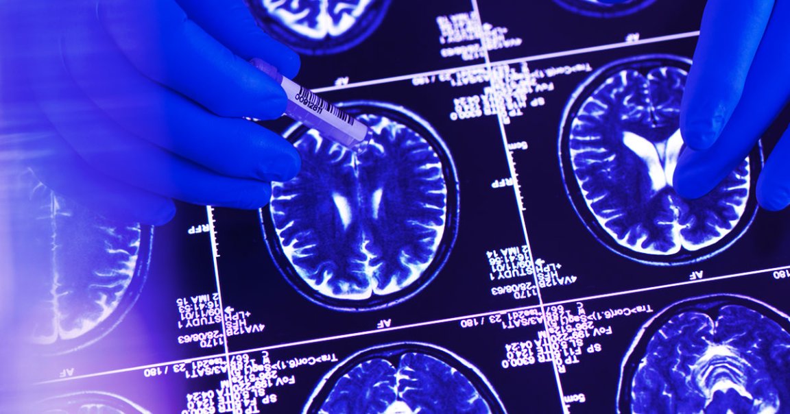 In a new study, scientists claim to have unlocked the secret of one man's extreme resilience to early-onset Alzheimer's.