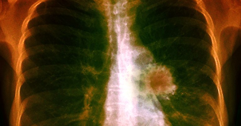 A decade-long global study has shown that a once-daily pill reduces the risk of dying from lung cancer by over half.