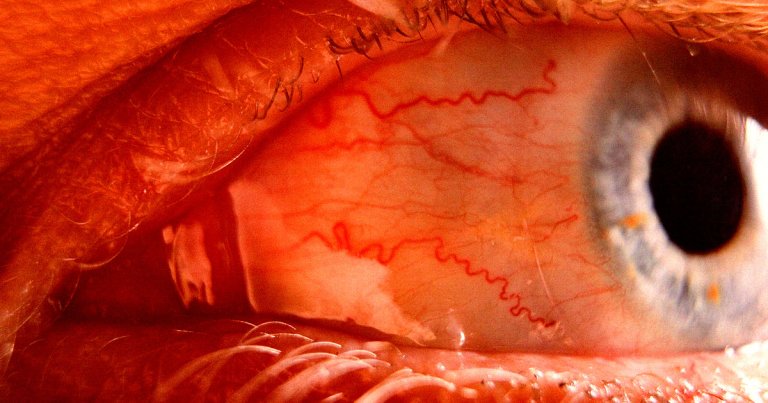 People are getting headaches from wearing the Apple Vision Pro. One user believes using the device led to a burst blood vessel in his eye.