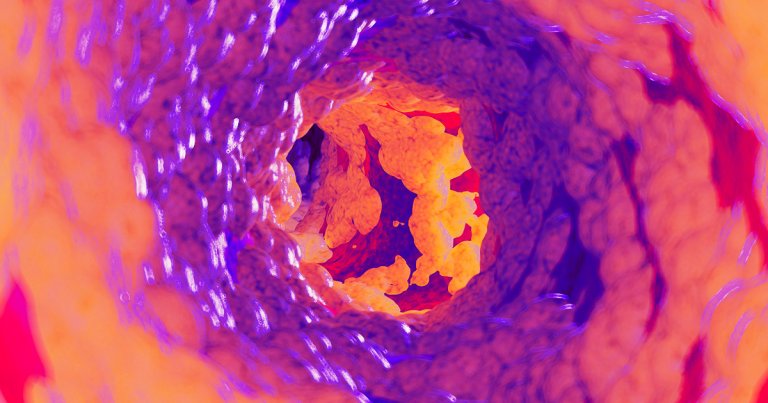 A new study came out in Nature Metabolism that suggests that eating excessive amount of protein is bad for your arteries.