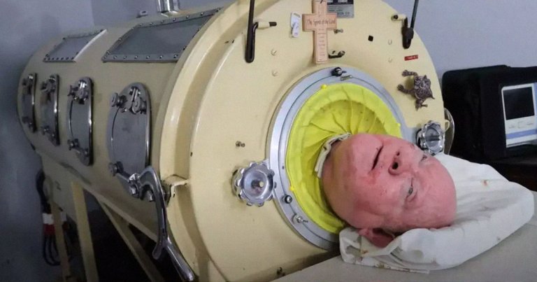 A 78-year-old man, who has been living inside an iron lung since surviving polio in the 1950s, has passed away. 