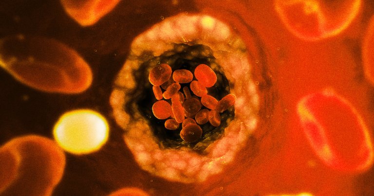 A new study linked the presence of microplastics in artery-clogging plaque to a higher risk of heart disease and even death.