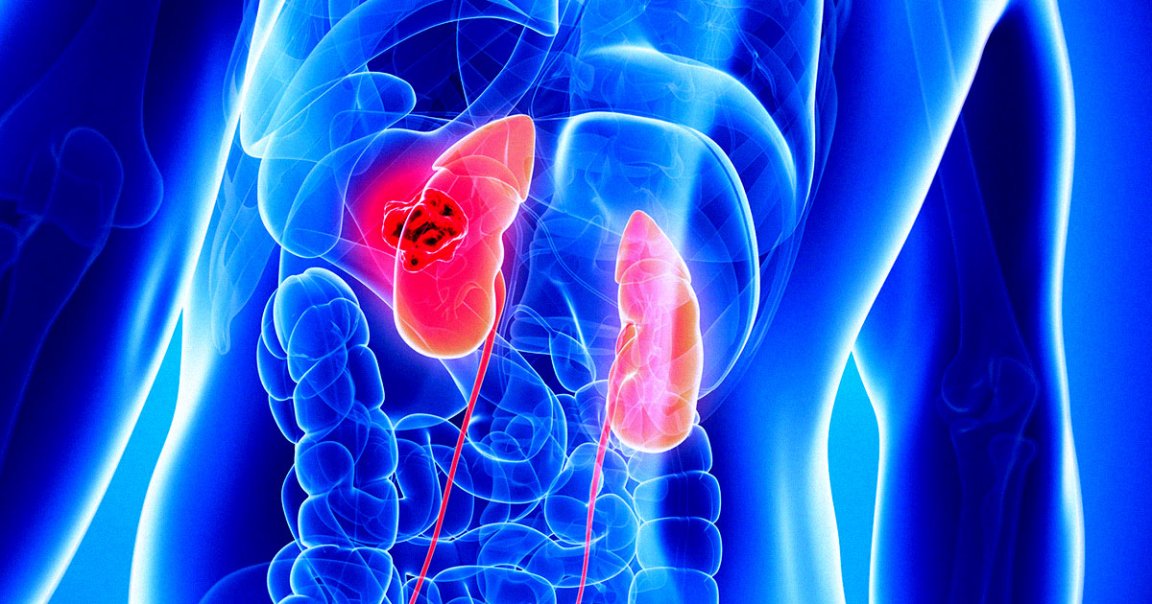 Surgeons at the Massachusetts General Hospital in Boston have transplanted a kidney from a gene-hacked pig into a living man.