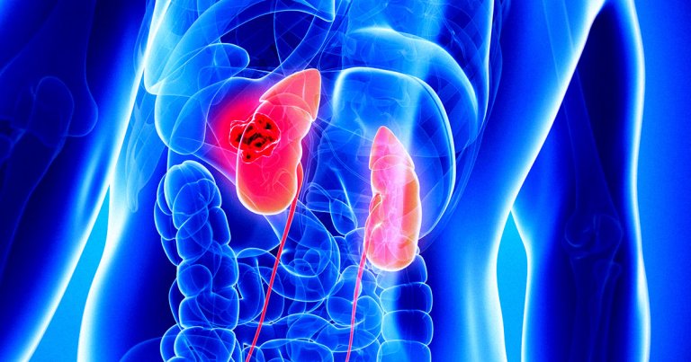 Surgeons at the Massachusetts General Hospital in Boston have transplanted a kidney from a gene-hacked pig into a living man.