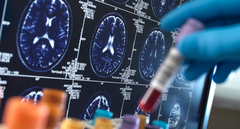 Neuralink has implanted its second brain chip into a human — even as the first person to ever get one admits that his has lost functionality. 