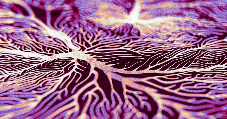 A new research consortium has found not only that brain fungi or bacteria cause some dementia cases, but also that it can be reversed.