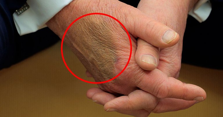 During a visit by Macron at the White House this week, a large, greenish-blue bruise appeared on the back of Donald Trump's right hand.