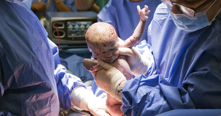 In Scotland, a woman successfully gave birth to a baby girl after getting a womb transplant from her sister.