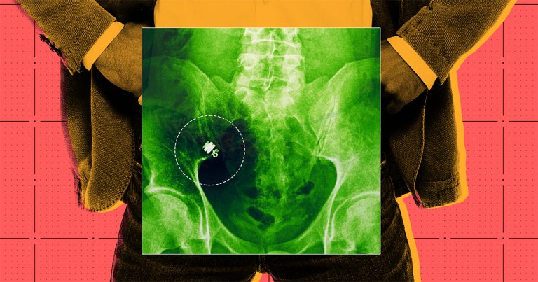 Adrian Thiessen had a vitamin-sized capsule camera trapped in his intestines for over six months. He says it saved his life.