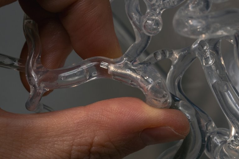 Researchers have developed a novel device that quite literally spins away the clots that block blood flow to the brain and cause strokes.