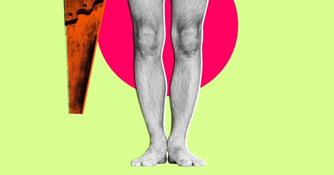 A surgeon was accused of fraud for getting his legs amputated and lying to insurance that the amputation was due to sepsis.