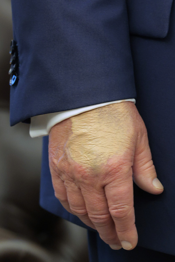 A close-up photo of president Donald Trump's right hand, which is partially covered in off-shade makeup. He wears a navy suit jacket with a white shirt peeking out. Image via Chip Somodevilla/Getty Images.