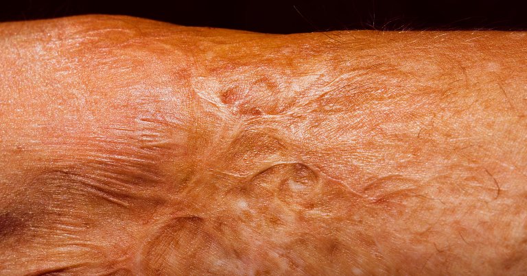 Scientists in Australia tested a new cream that's now been proven to fade older mature scars such as keloids.