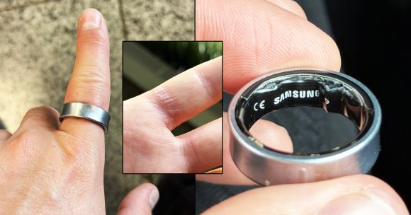 A faulty Samsung Galaxy Ring battery caused the smart ring to swell up, sending its wearer to the emergency room for removal.