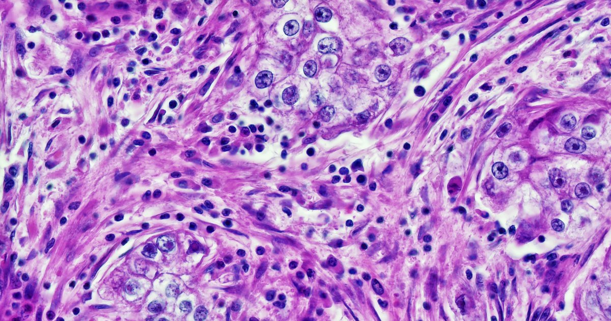 Doctors Catch Cancer-Diagnosing AI Extracting Patients' Race Data and Being Racist With It