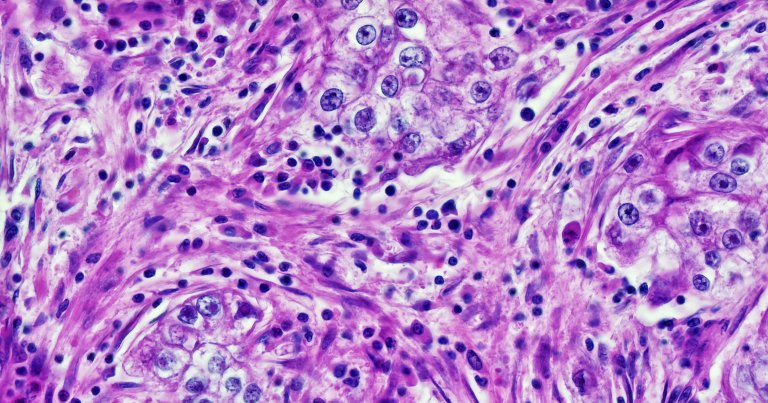 A new study reveals an alarming bias present in four leading AI cancer screening tools, related to race, gender, and age.