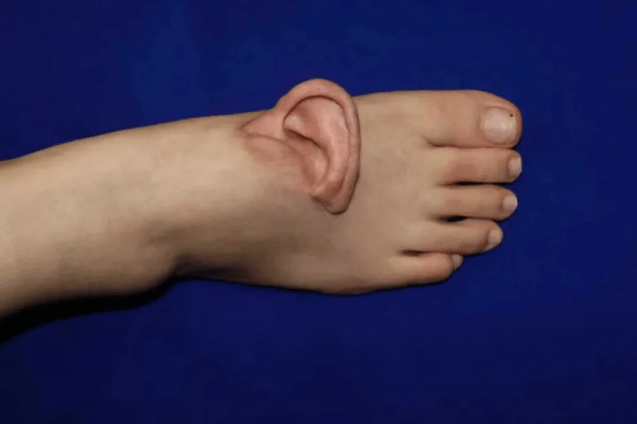 A surgical team in China successfully grafted a human patient's ear to their foot in a remarkable medical intervention.