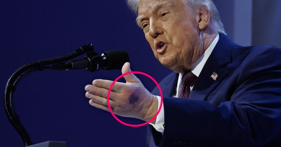Photos of Trump at this year's World Economic Forum in Switzerland show an even gnarlier darkish bruise on his left hand.