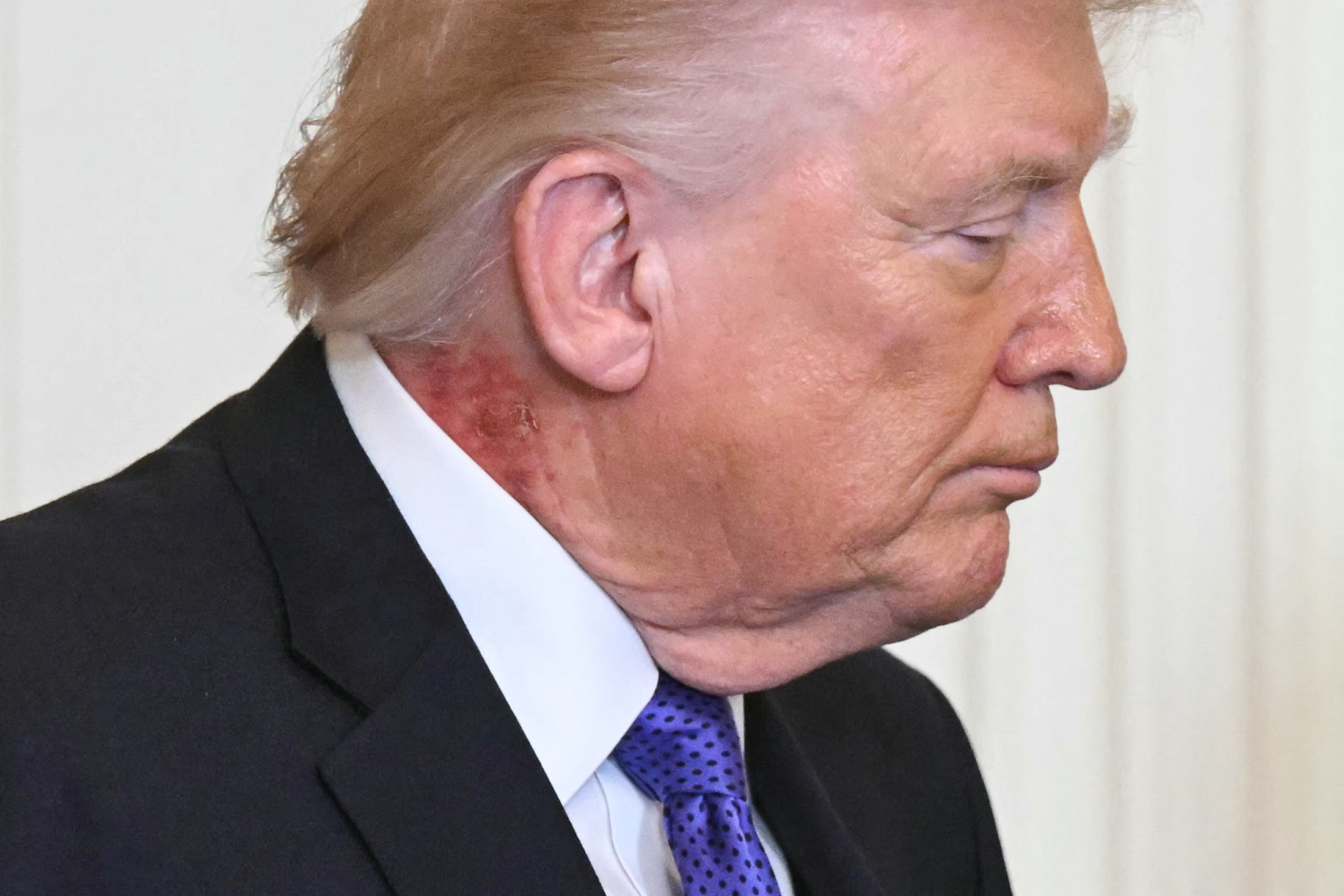 Profile view of president Donald Trump. There is a noticeable red, irritated patch of skin on the left side of his neck.