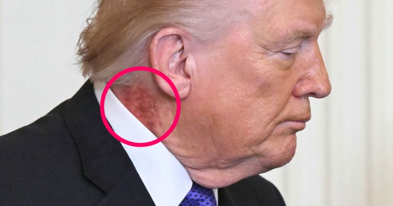 At an event today, onlookers noticed a "significant rash-like injury" on the right side of president Donald Trump's neck.