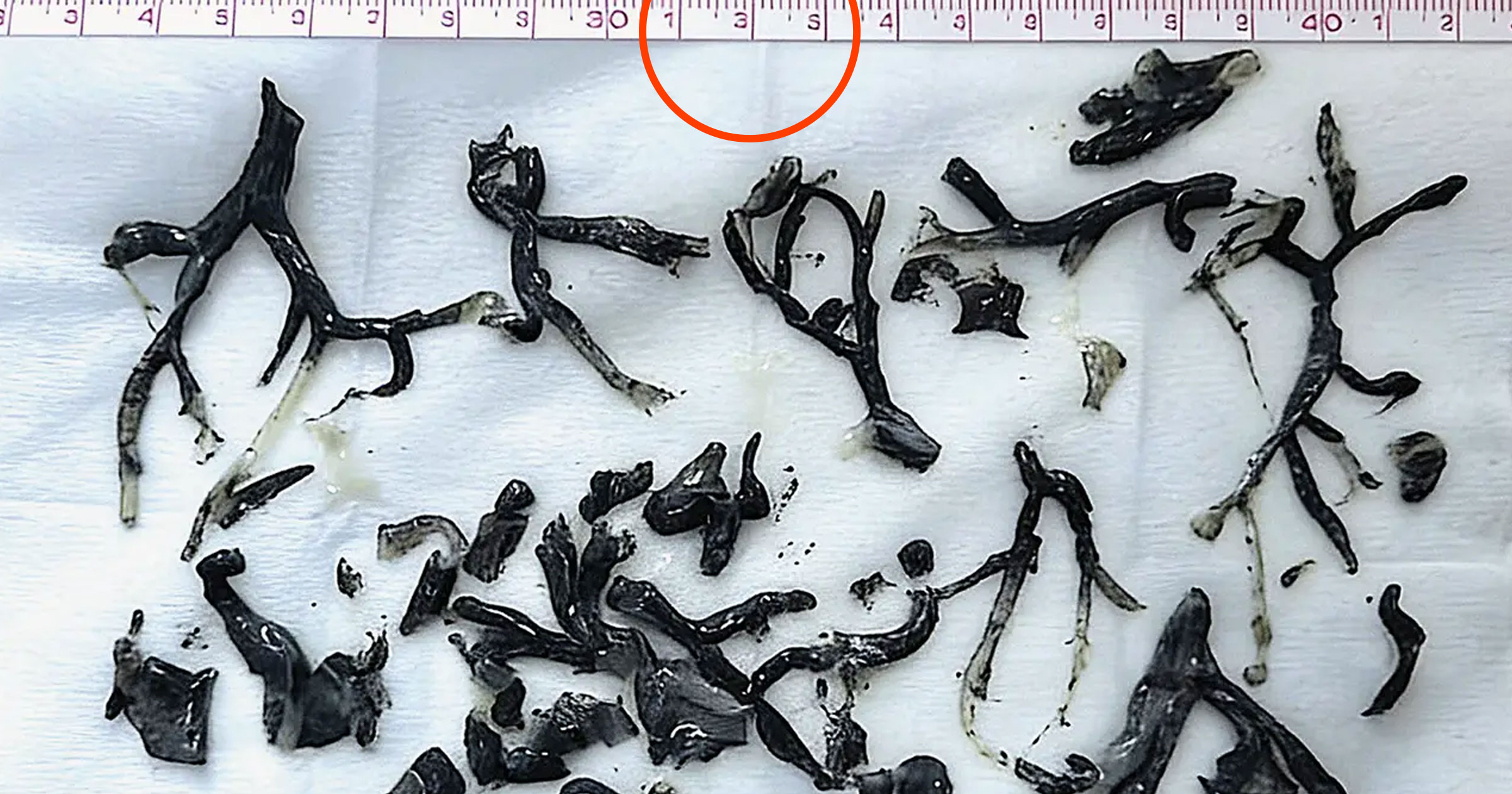 futurism.com - Victor Tangermann - New England Journal of Medicine Retracts Paper Because Photo of Patient's Insides Was Garbled by AI