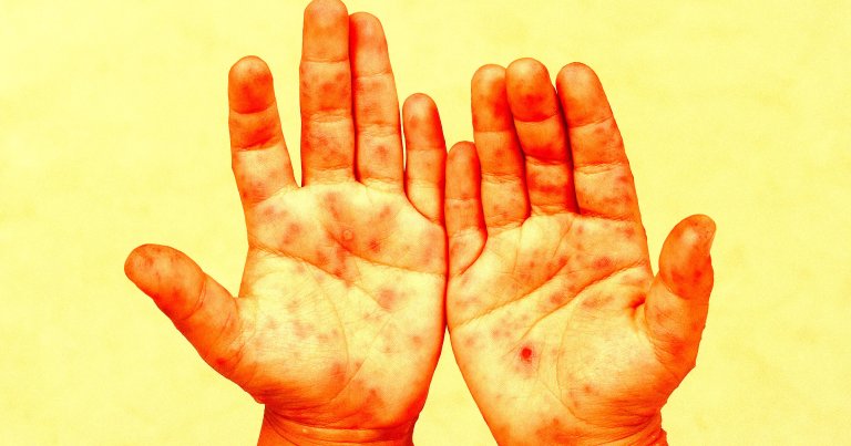 Rash and red blisters on the hands of a child.